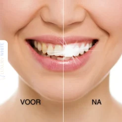 Luxury White Pro-LED Tandenbleek Set Sale