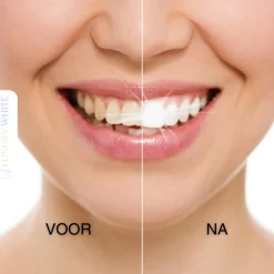 Luxury White Whitening Strips Outlet